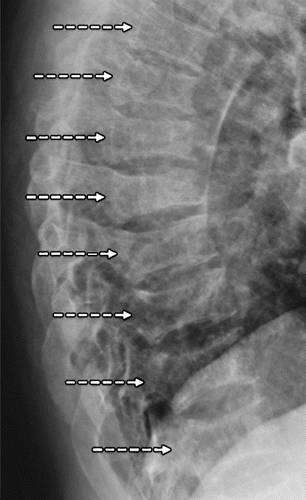 代谢性骨病的影像学表现:佝偻病和骨软化症Rickets and Osteomalacia 代谢性骨病的影像学表现:佝偻病和骨软化症Rickets and Osteomalacia