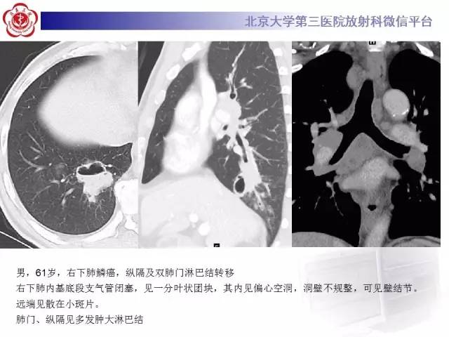 【病例】肺内空洞性病变鉴别诊断