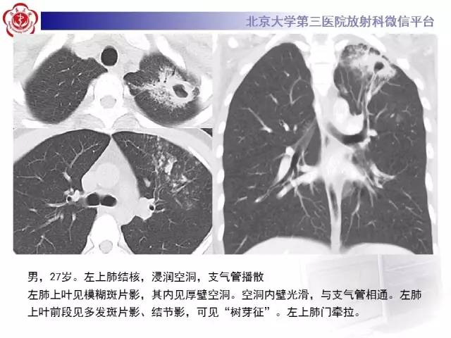 【病例】肺内空洞性病变鉴别诊断