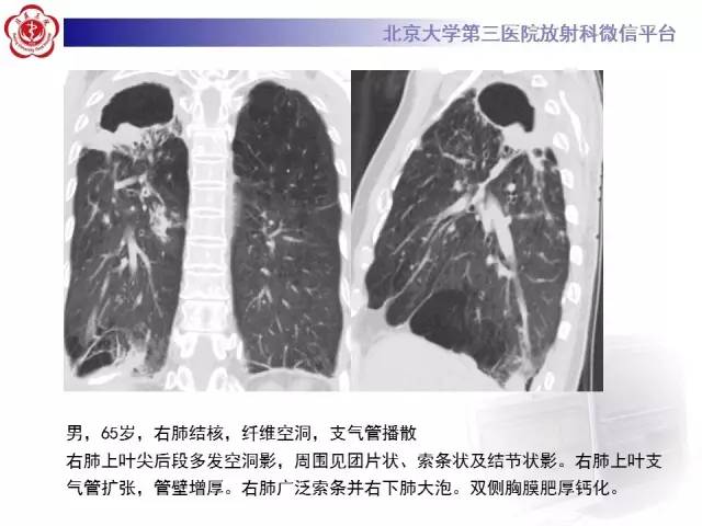 【病例】肺内空洞性病变鉴别诊断