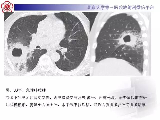 【病例】肺内空洞性病变鉴别诊断