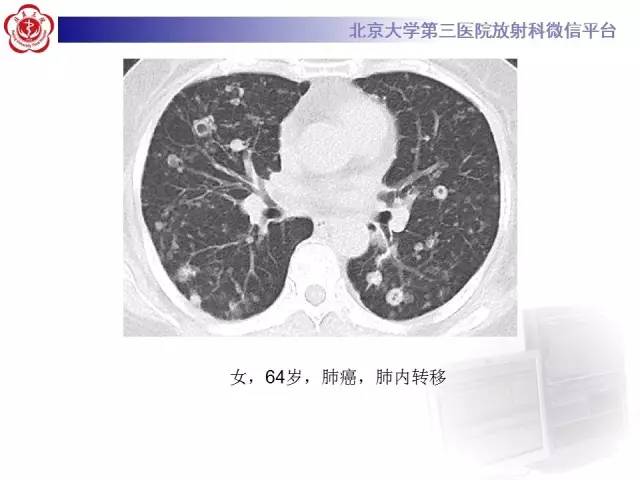 【病例】肺内空洞性病变鉴别诊断