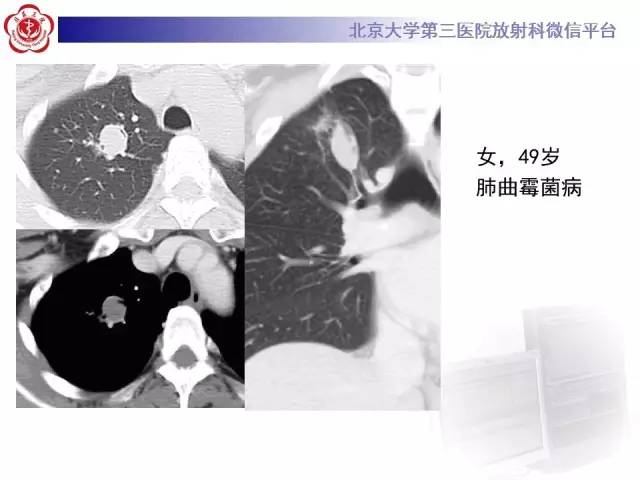 【病例】肺内空洞性病变鉴别诊断