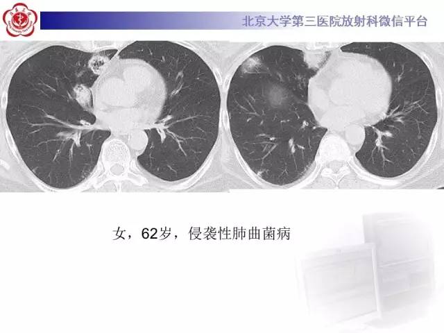 【病例】肺内空洞性病变鉴别诊断