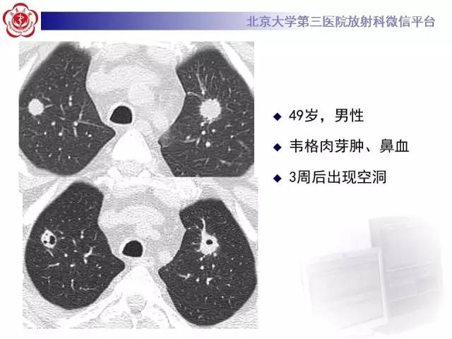 【病例】肺内空洞性病变鉴别诊断