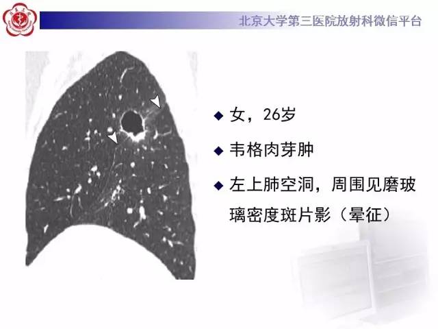 【病例】肺内空洞性病变鉴别诊断