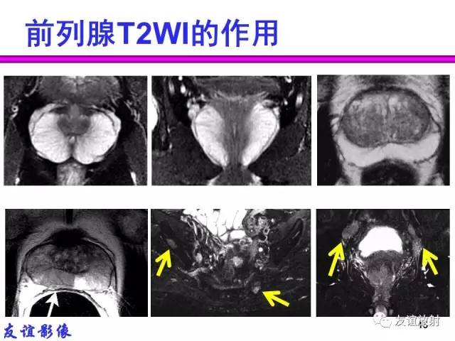 【PPT】前列腺的多参数MRI检查与病变的PI-RADS分类