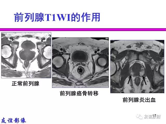 【PPT】前列腺的多参数MRI检查与病变的PI-RADS分类