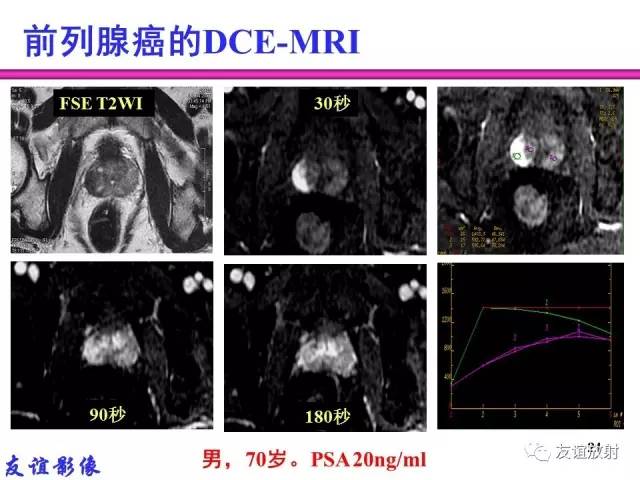 【PPT】前列腺的多参数MRI检查与病变的PI-RADS分类