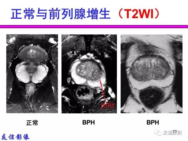 【PPT】前列腺的多参数MRI检查与病变的PI-RADS分类