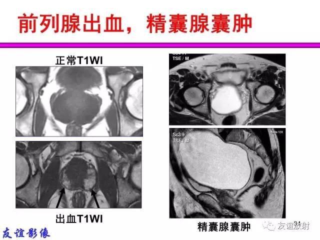 【PPT】前列腺的多参数MRI检查与病变的PI-RADS分类