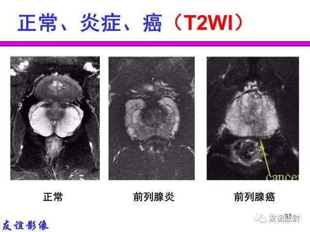 【PPT】前列腺的多参数MRI检查与病变的PI-RADS分类