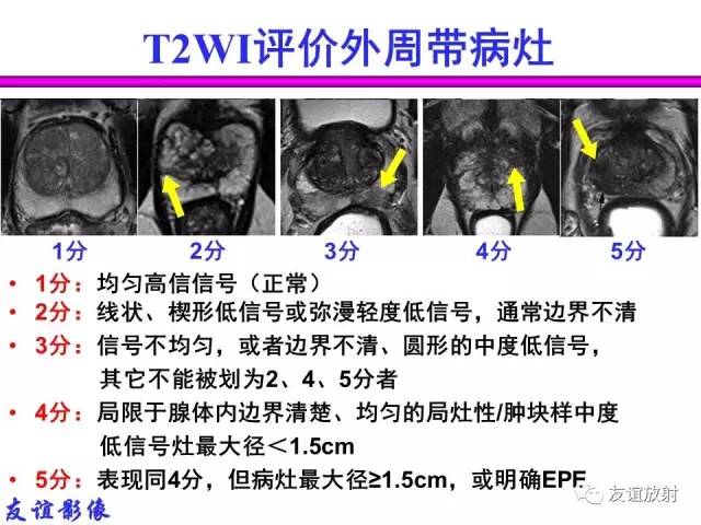 【PPT】前列腺的多参数MRI检查与病变的PI-RADS分类