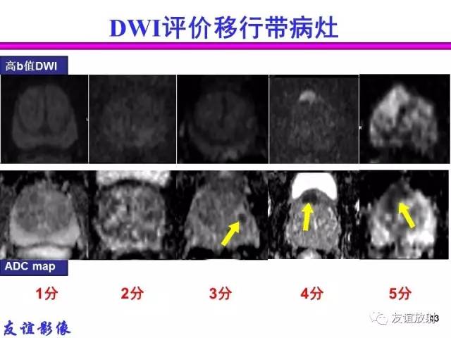 【PPT】前列腺的多参数MRI检查与病变的PI-RADS分类