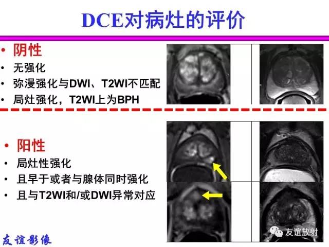 【PPT】前列腺的多参数MRI检查与病变的PI-RADS分类