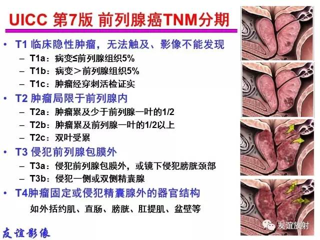 【PPT】前列腺的多参数MRI检查与病变的PI-RADS分类