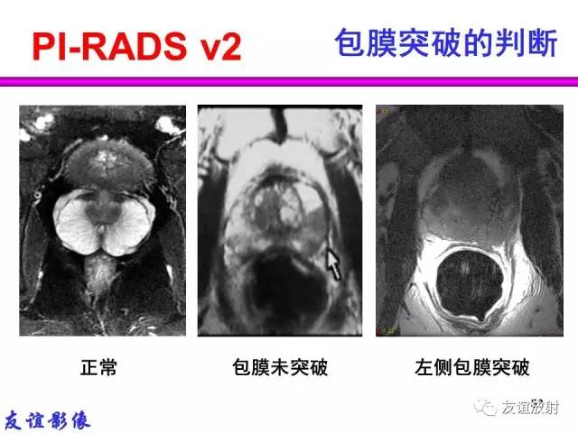 【PPT】前列腺的多参数MRI检查与病变的PI-RADS分类