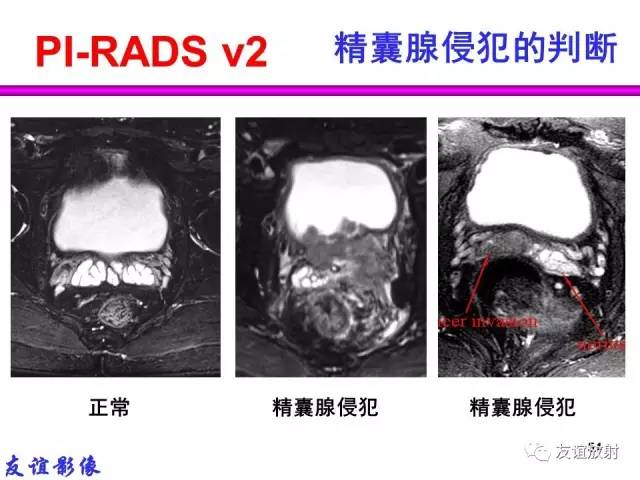 【PPT】前列腺的多参数MRI检查与病变的PI-RADS分类