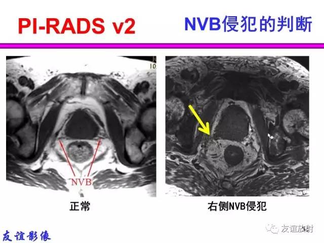 【PPT】前列腺的多参数MRI检查与病变的PI-RADS分类