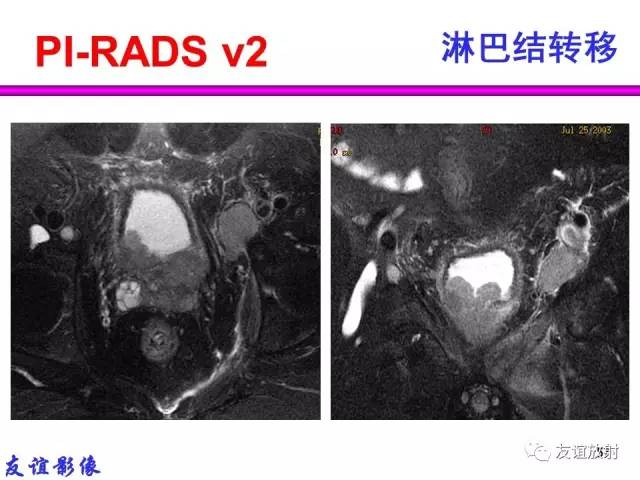 【PPT】前列腺的多参数MRI检查与病变的PI-RADS分类