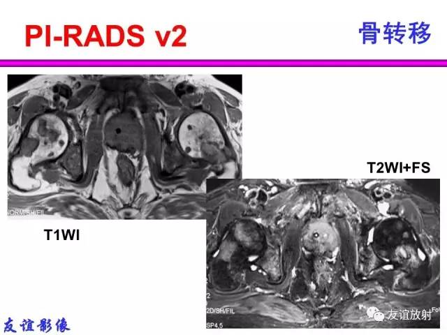 【PPT】前列腺的多参数MRI检查与病变的PI-RADS分类