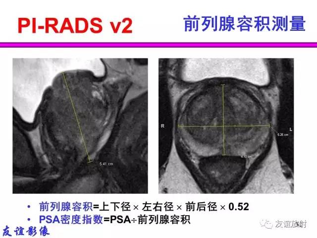 【PPT】前列腺的多参数MRI检查与病变的PI-RADS分类
