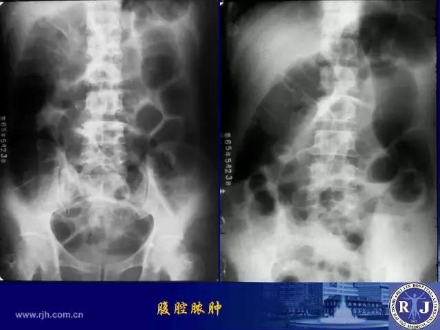 【PPT】反射性肠郁积的影像学表现
