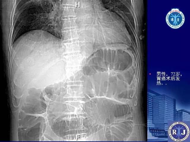 【PPT】反射性肠郁积的影像学表现