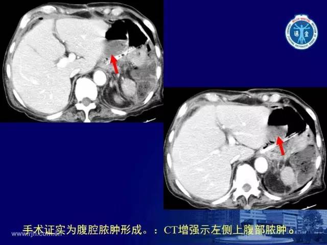 【PPT】反射性肠郁积的影像学表现