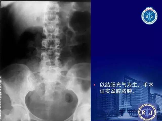 【PPT】反射性肠郁积的影像学表现