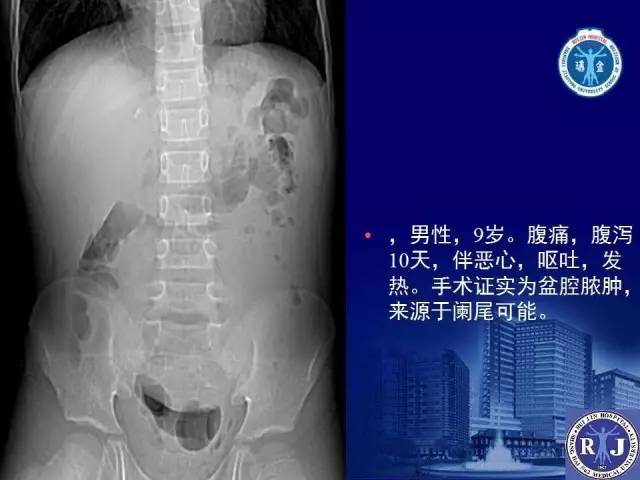 【PPT】反射性肠郁积的影像学表现