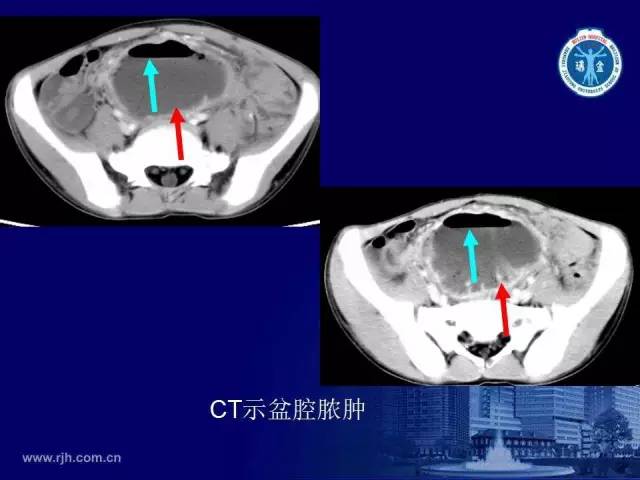 【PPT】反射性肠郁积的影像学表现