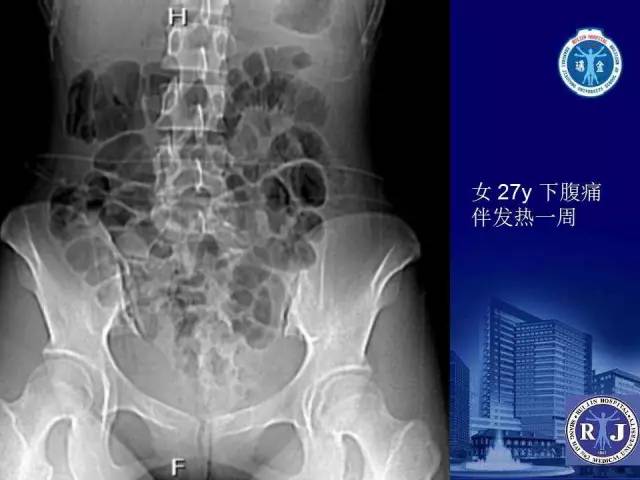 【PPT】反射性肠郁积的影像学表现