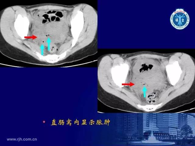 【PPT】反射性肠郁积的影像学表现