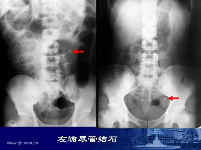 【PPT】反射性肠郁积的影像学表现