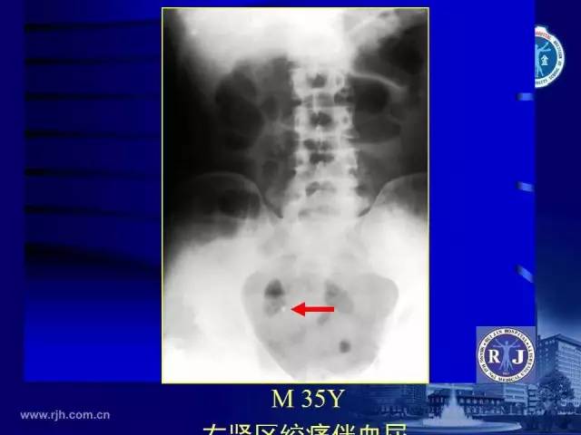 【PPT】反射性肠郁积的影像学表现