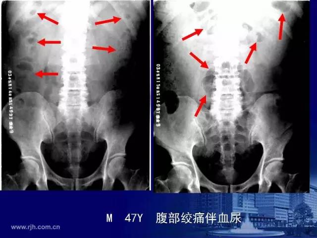 【PPT】反射性肠郁积的影像学表现