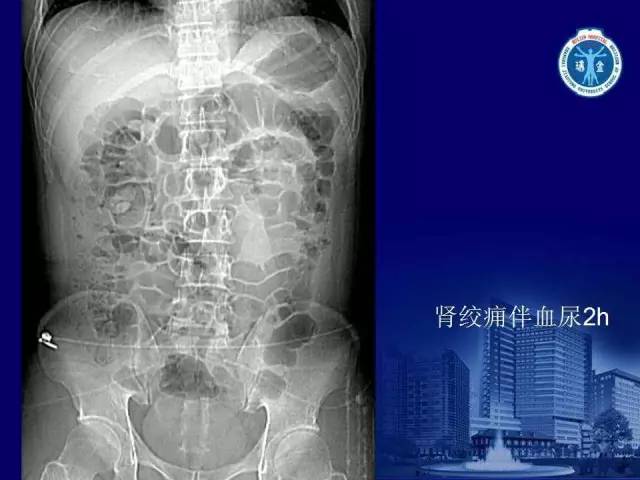 【PPT】反射性肠郁积的影像学表现