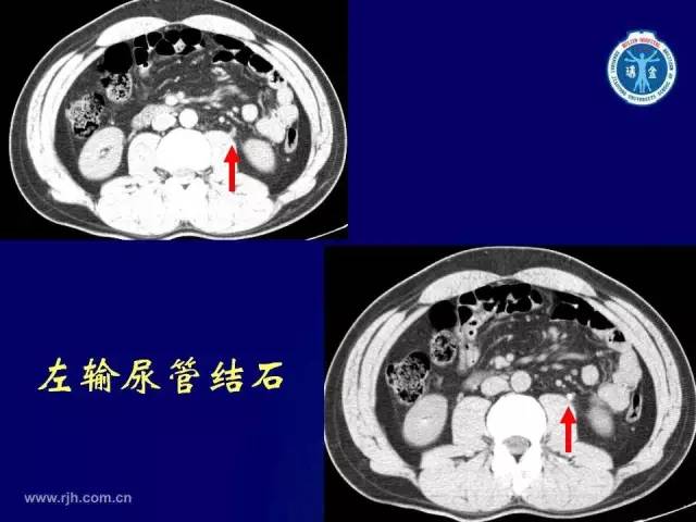 【PPT】反射性肠郁积的影像学表现