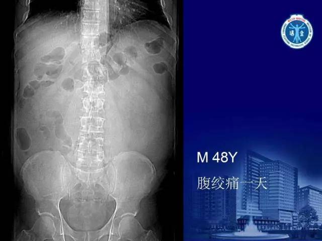 【PPT】反射性肠郁积的影像学表现
