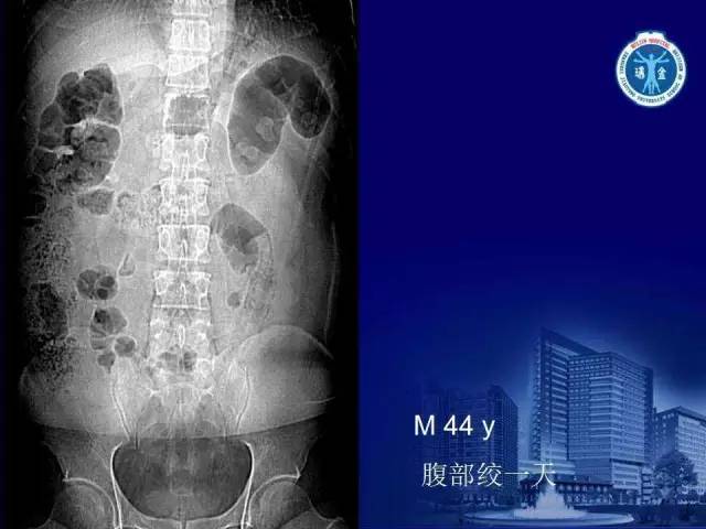 【PPT】反射性肠郁积的影像学表现
