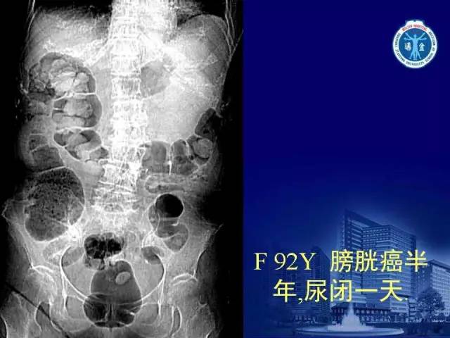 【PPT】反射性肠郁积的影像学表现