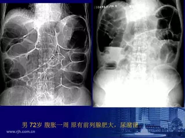 【PPT】反射性肠郁积的影像学表现