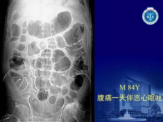 【PPT】反射性肠郁积的影像学表现