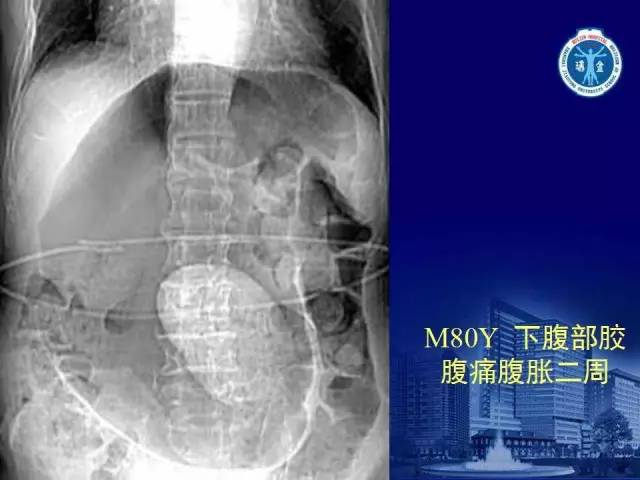 【PPT】反射性肠郁积的影像学表现