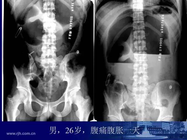 【PPT】反射性肠郁积的影像学表现