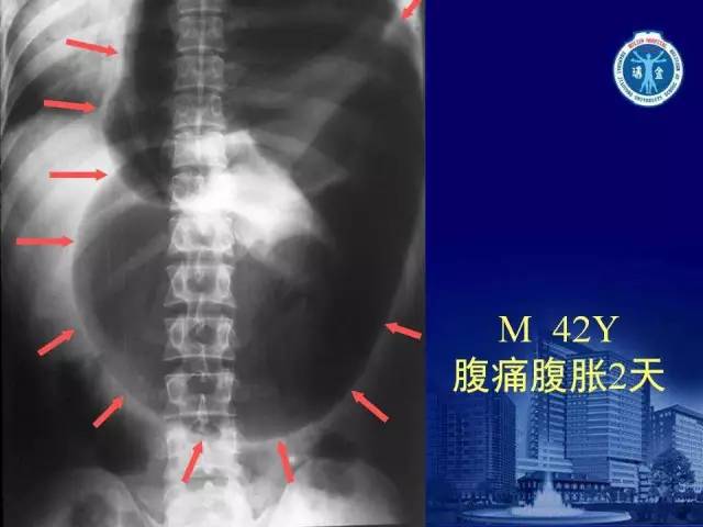 【PPT】反射性肠郁积的影像学表现
