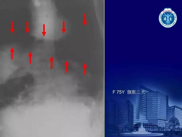 【PPT】反射性肠郁积的影像学表现