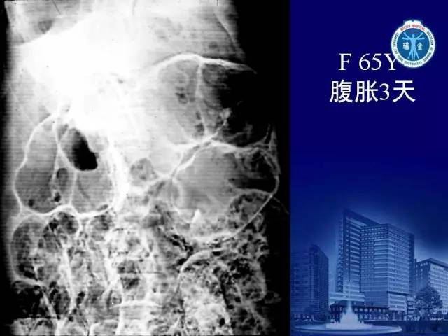 【PPT】反射性肠郁积的影像学表现