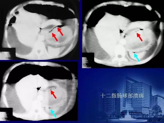 【PPT】反射性肠郁积的影像学表现